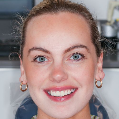 Composite Bonding - Niamh O'Sullivan - After